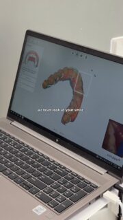 Protection, designed around you 🦷🔍
Our custom mouth guards are created using precise scans for a fit that feels secure, comfortable, and easy to wear. Anyone due for a mouth guard? 👀
#ottawadentistry #ottawadental #mouthguards #custommouthguard